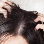 5 Ways to Get Rid of Dandruff in Winters