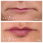 Experience the miraculous benefits of dermal fillers
