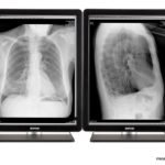 Refurbished Barco Coronis 3MP Pair Radiology Monitors – MDCG-3221