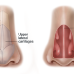 Rhinoplasty surgeon