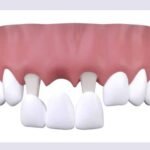 Most Common Problems With Dental Bridges You May Encounter