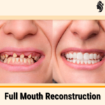 Full Mouth Reconstruction Unveiled – Necessity, Processes, and Duration