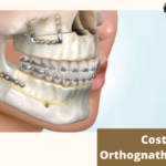 Cost of Orthognathic Surgery in India: A Comprehensive Guide by Leading Jaw Surgeon
