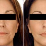Unlock Youthful Radiance: Transform with Facelift Surgery by Top Oral Surgeon in India