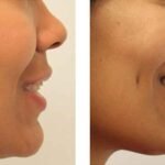Dimple Creation Surgery by Expert Plastic Surgeon in Indore