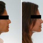 Open vs. Closed Rhinoplasty: Which Technique Is Right for You?