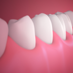 Gum Disease Treatment Near You | Slough, Windsor, Maidenhead and Burnham