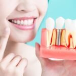 Dental Implants in Bangalore: Restore Your Smile with Expert Care