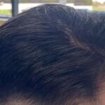 Minoxidil & Finasteride: Are They Right for Your Hair Loss?