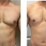 Best Rhinoplasty Surgeon in Delhi NCR – Why Patients Trust Dr. Vivek Kumar for Precision, Safety & Natural Results